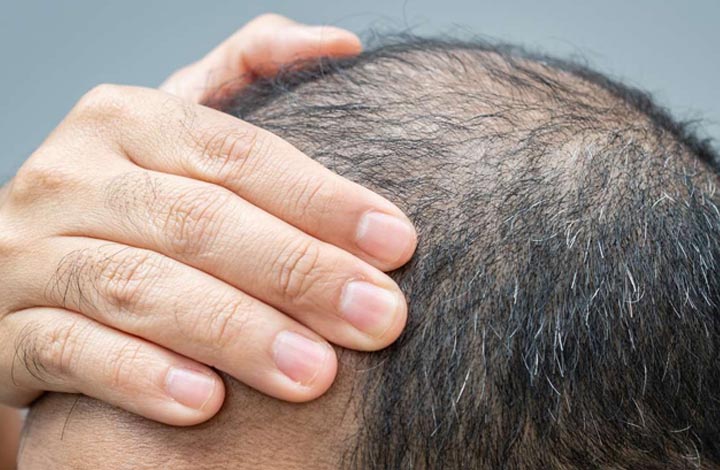 از آلوپسی تا تلوژن افلوویوم: راهنمای تشخیص و درمان ریزش مو