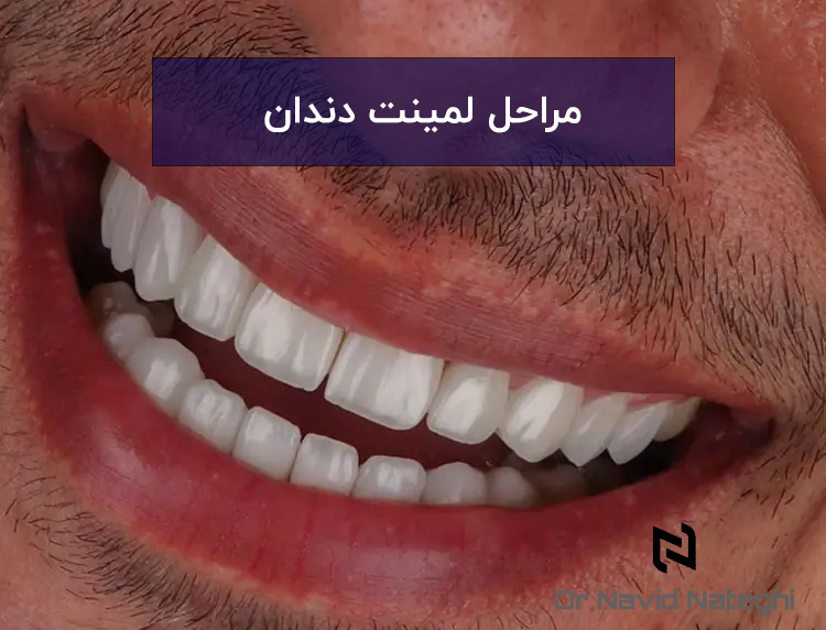 هر آنچه باید درباره مراحل لمینت دندان بدانید!