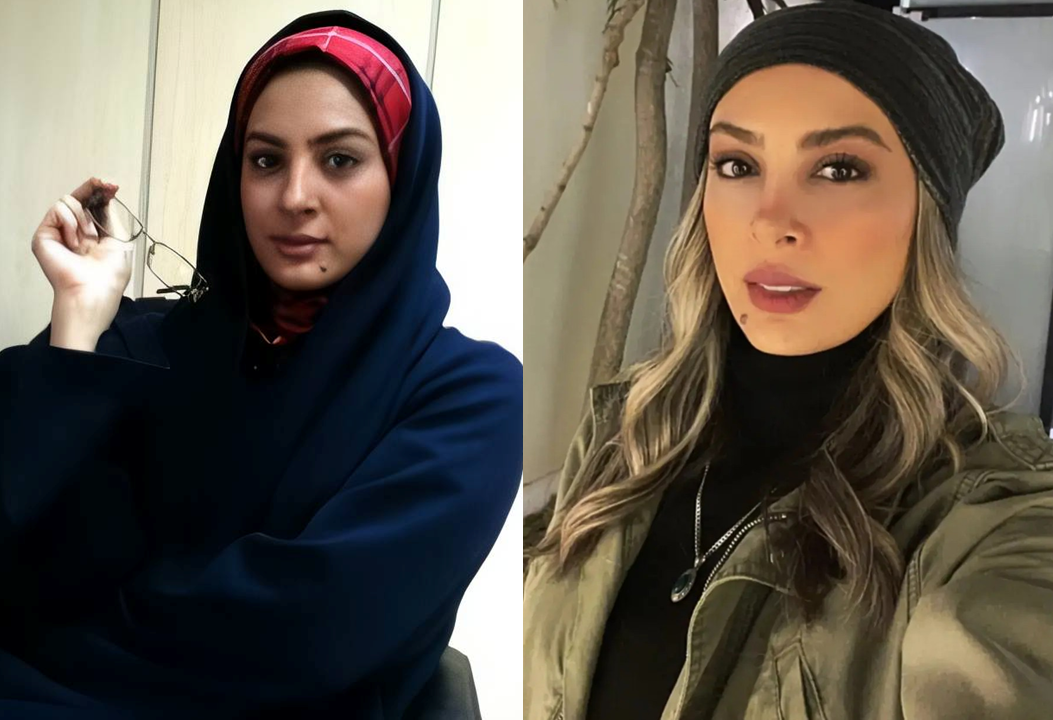 قبل و بعد عملی بینی حدیثه تهرانی