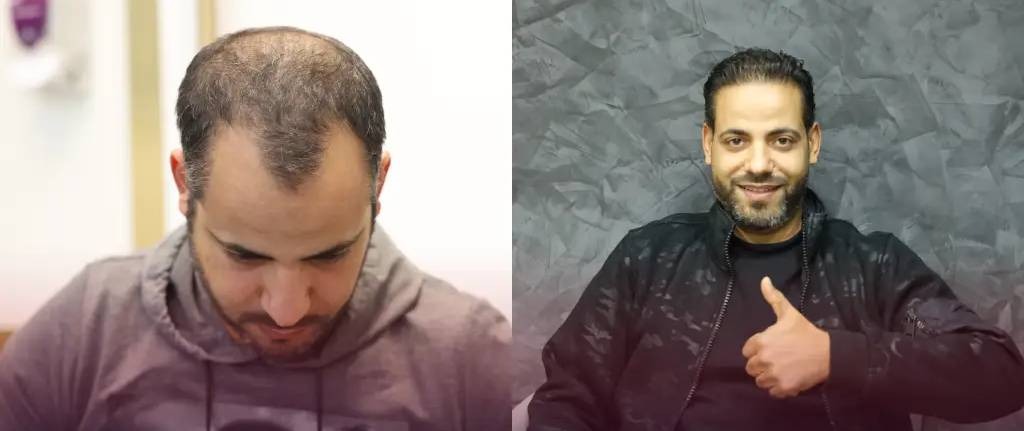 عکس قبل و بعد کاشت مو