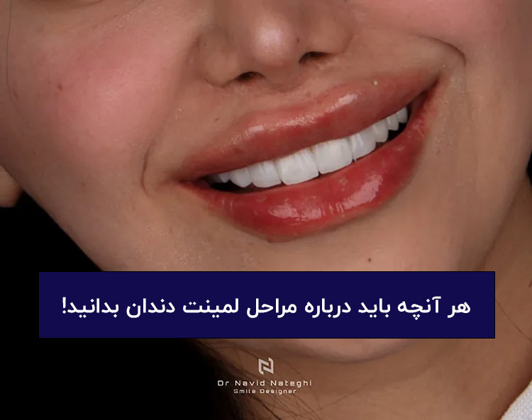 بررسی تخصصی مراحل لمینت دندان از زبان دکتر ناطقی