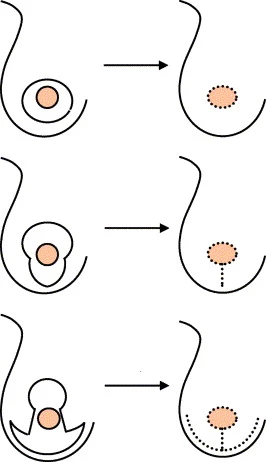 مراحل جراحی ماموپلاستی با تکنیک اتوپروتز