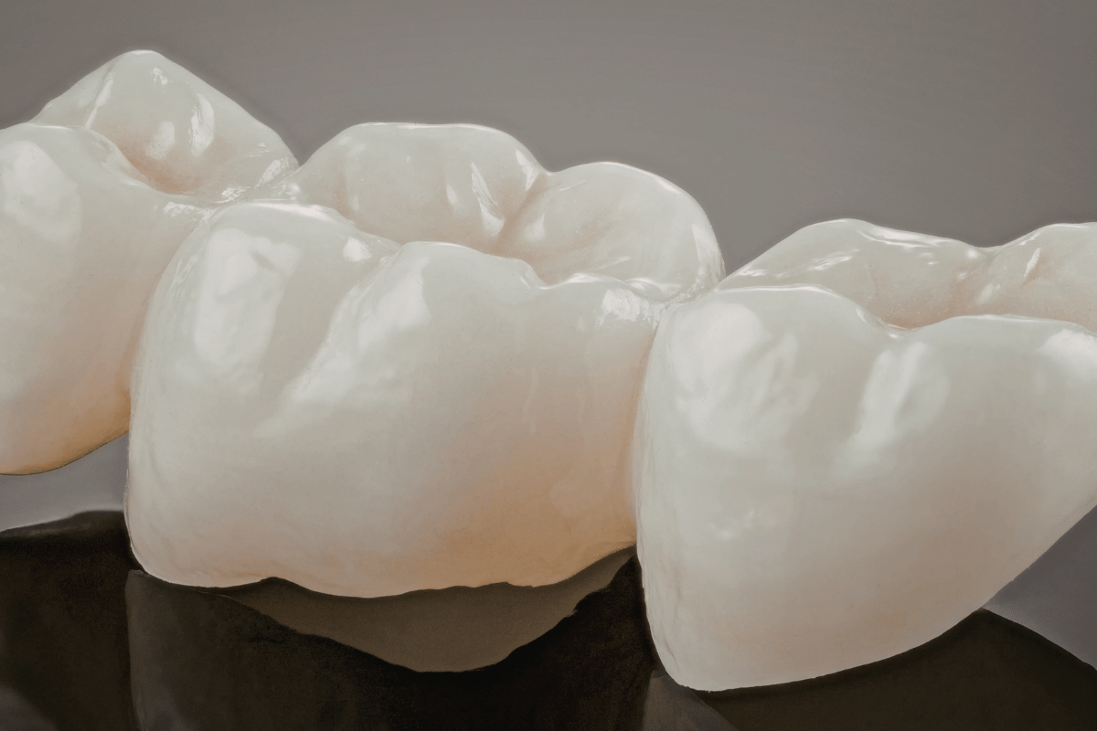 ایمپلنت دندان