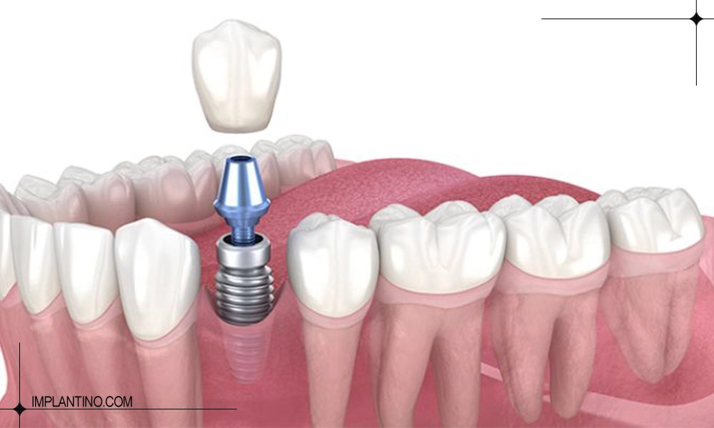 کاشت دندان با رعایت ترتیب مراحل ایمپلنت دندان