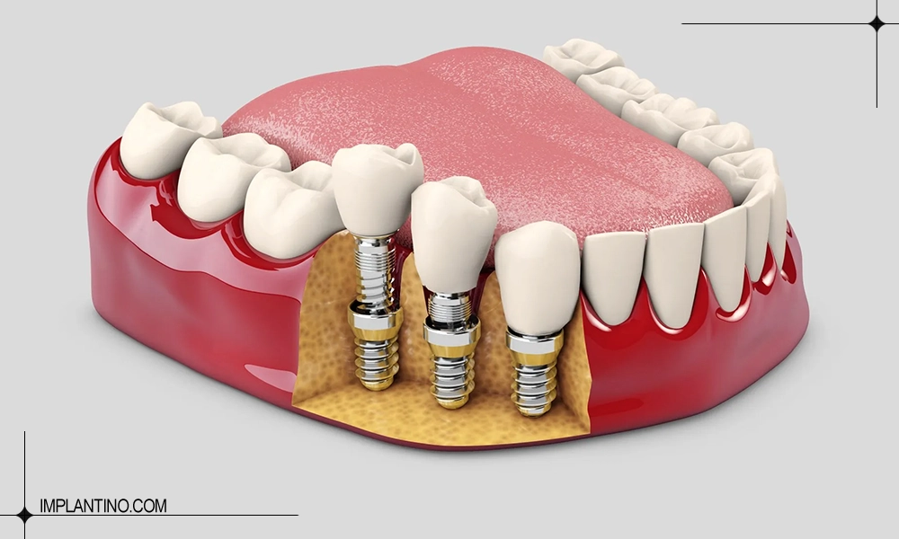 دندان های کاشته شده بعد از طی کردن مراحل ایمپلنت دندان