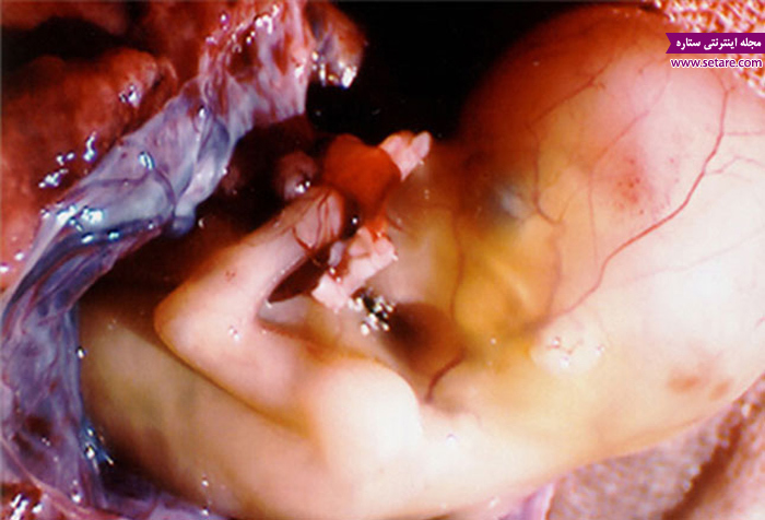 حاملگی خارج از رحم - بارداری خارج از رحم - عکس بارداری