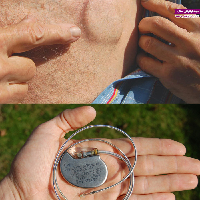 علت تپش قلب - درمان تپش قلب -دستگاه ضربان ساز قلب - Pace maker