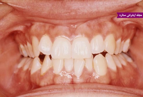 عادات مخرب برای سلامت دهان و دندان - دندان قروچه