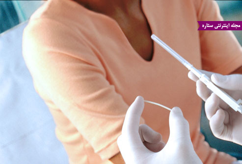 پیشگیری از بارداری - روش کاشتنی ضد بارداری - کاشت ایمپلنت جلوگیری از حاملگی
