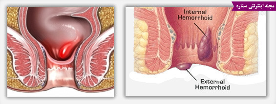 بیماری بواسیر یا هموروئید چیست و چگونه درمان می‌شود؟