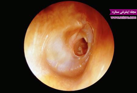 عفونت گوش میانی – درمان عفونت گوش – علت عفونت گوش – گوش درد – عوارض عفونت گوش – علائم عفونت گوش - پاره شدن پرده گوش