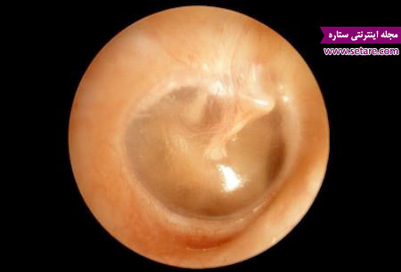 عفونت گوش میانی – درمان عفونت گوش – علت عفونت گوش – گوش درد – عوارض عفونت گوش – علائم عفونت گوش - تشخیص عفونت گوش