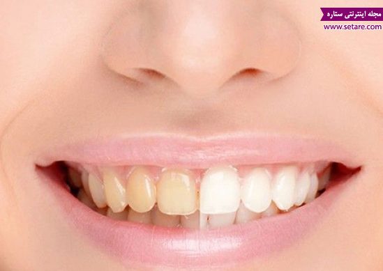 سفید کردن دندان در دو دقیقه! - ستاره