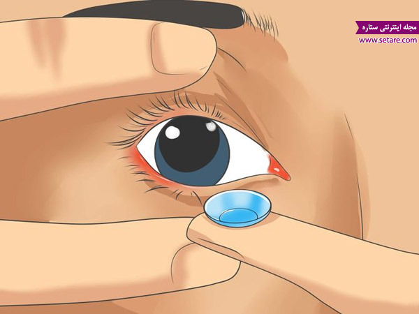 قراردادن لنز روی چشم - گذاشتن لنز در چشم