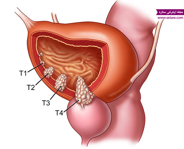 سرطان مثانه - مرحله بندی سرطان مثانه - درجه بندی سرطان مثانه - نفوذ تومور در بافت مثانه - تشخیص سرطان مثانه