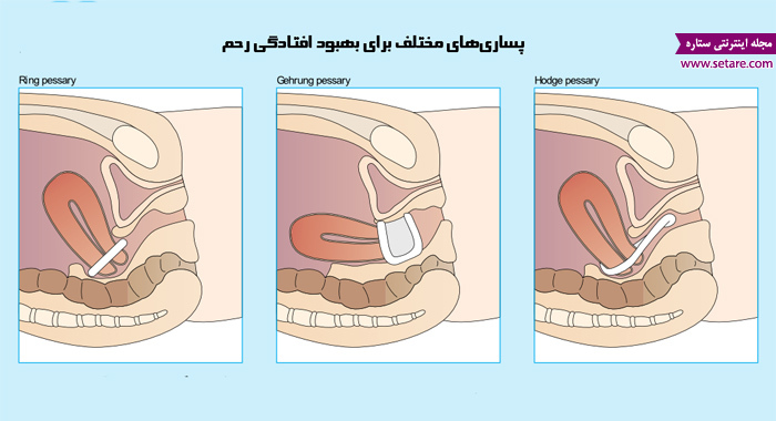 قرار دادن پساری داخل واژن - درمان افتادگی رحم