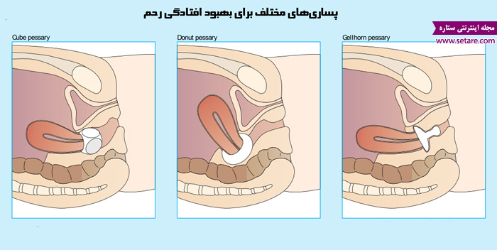 قرار دادن پساری داخل واژن - درمان افتادگی رحم