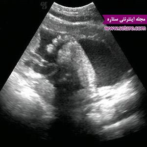 عکس جنین در هفته سی و دوم بارداری