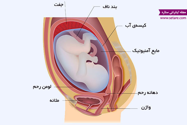 پارگی زودرس کیسه آب در بارداری