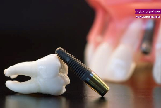 ایمپلنت دندان - ایمپلنت قیمت - هزینه ایمپلنت - عکس کاشت دندان