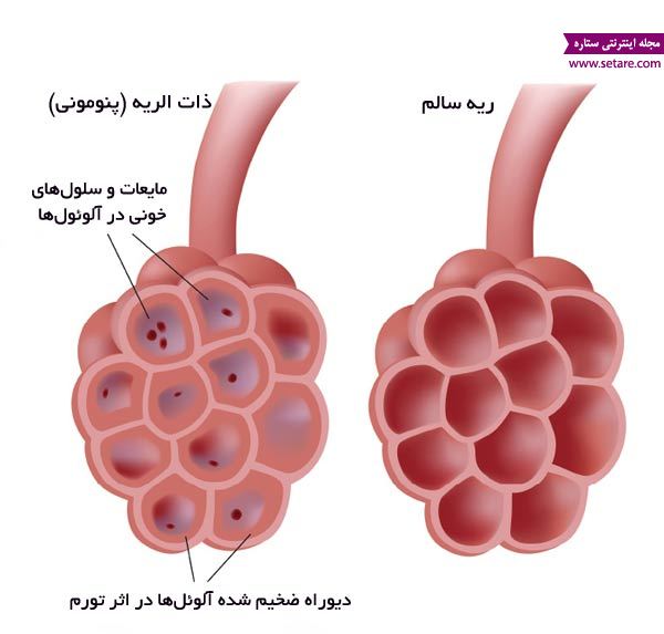 ذات الریه - عکس عفونت ریه