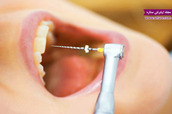 نکروز دندان - نکروز چیست - درمان ریشه - عصب کشی دندان