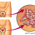 هرپس تناسلی
