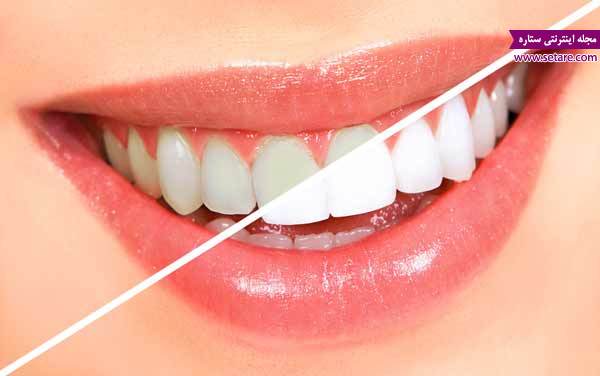 سفید کردن دندان - بیلیچینگ 
