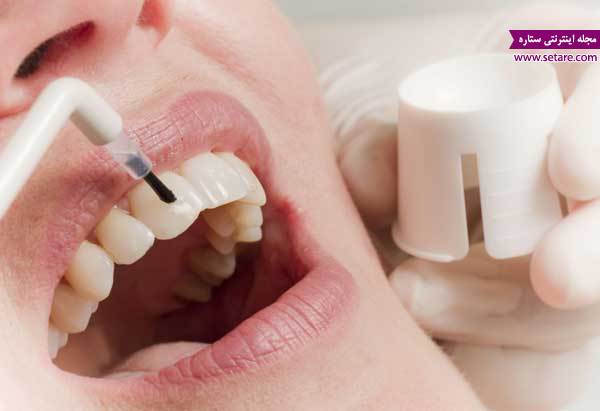 سفید کردن دندان - جرم‌گیری دندان