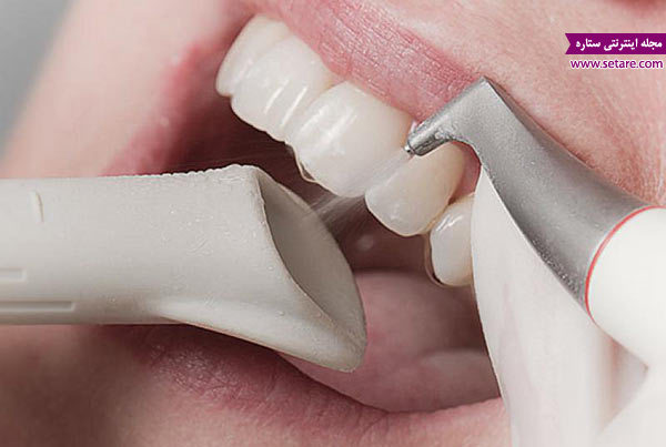 سفید کردن دندان - جرم گیری دندان