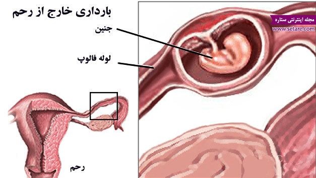 علت و علائم بارداری خارج رحم چیست؟