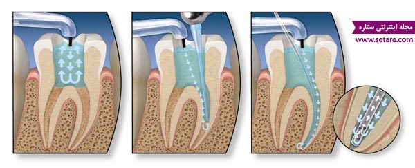 عصب کشی دندان – درد دندان – روکش دندان