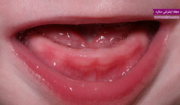 دندان دراوردن نوزاد – درد دندان 