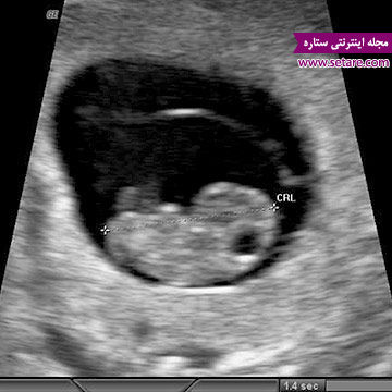 سونوگرافی در بارداری - هفته هشتم بارداری - هفته های بارداری - بارداری هفته بههفته