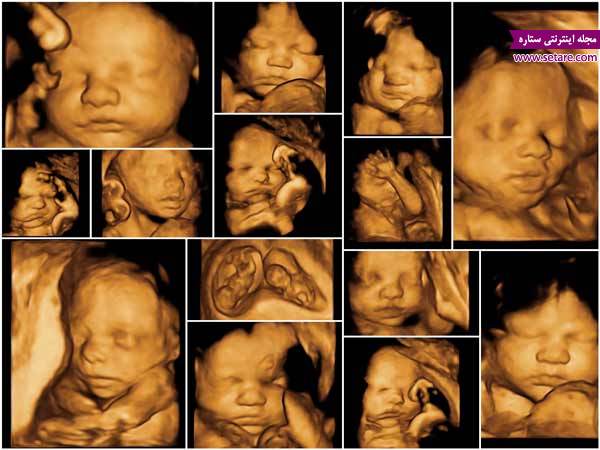  سونوگرافی سه بعدی – سونوگرافی 3 بعدی – سونوگرافی بارداری –  سونوگرافی 