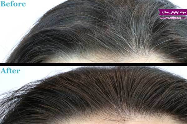 درمان خانگی رفع سفیدی مو، رفع سفیدی مو با مواد طبیعی، علت سفیدی زودرس مو 