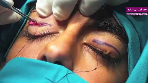  علت افتادگی پلک چشم - درمان افتادگی پلک چشم با جراحی