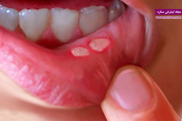 درمان زخم دهان، درمان آفت دهان با طب سنتی، درمان خانگی زخم دهان، علت زخم دهان