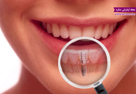 ایمپلنت دندان - هزینه ایمپلنت دندان - قیمت ایمپلت دندان