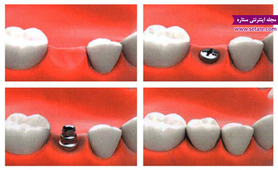 قیمت ایمپلنت دندان - عکس ایمپلنت - کاشت دندان