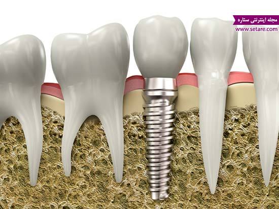 ایمپلنت دندان چیست - ایمپلنت دندان جلو - عکس ایمپلنت دندان
