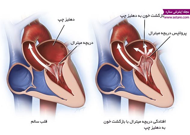 آیا افتادگی دریچه میترال قلب خطرناک است؟