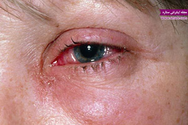 عکس آب سیاه چشم، بیماری آب سیاه، گلوکوم چیست، درمان خانگی آب سیاه، درمان آب سیاه چشم در طب سنتی