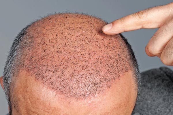 مراقبت‌های بعد از کاشت مو؛ بایدها و نبایدها