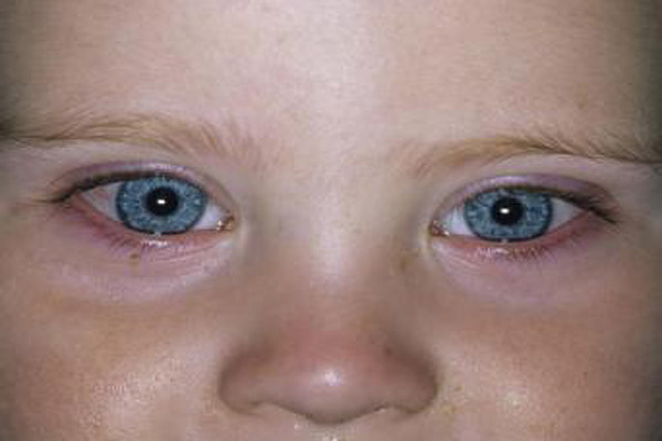 قی کردن چشم نوزاد: بیماری چشم صورتی (التهاب ملتحمه) در نوزادان و کودکان