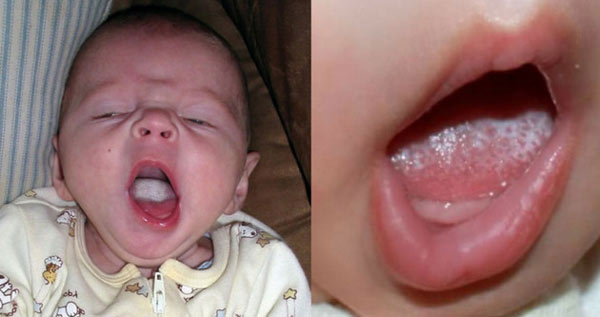 دلایل عفونت دهان از نوع برفک دهانی چیست؟