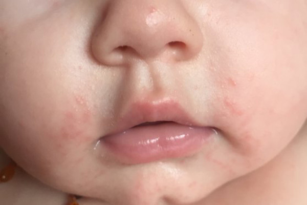 آب دهان نوزاد شما طبیعی است و یا باعث بثورات پوستی شده است؟