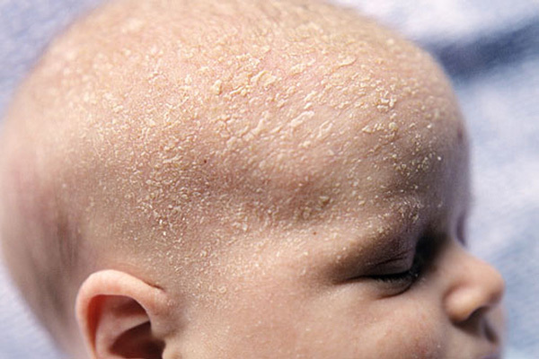 نکات مهم و روش درمان ریزش پوست سر نوزاد در سال 2018