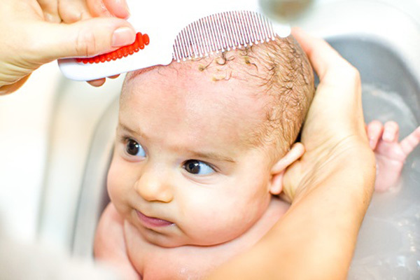 نکات مهم و روش درمان ریزش پوست سر نوزاد در سال 2018