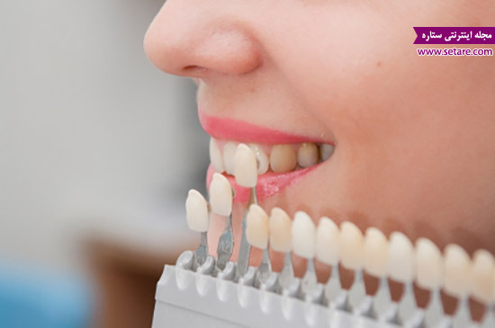 هزینه روکش دندان - روکش دندان چیست - انواع روکش دندان